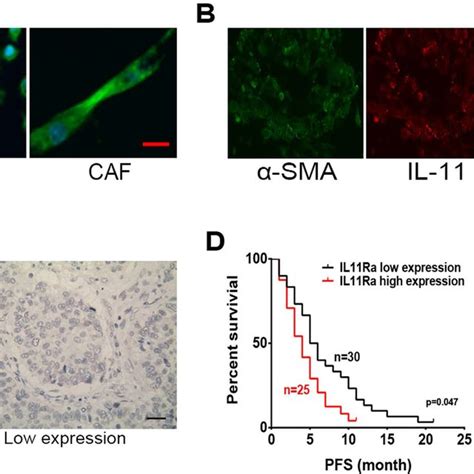 The Expression Of Il 11rα In Lung Adenocarcinoma Cellstissue And Its