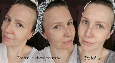 Peeling Chemiczny Perfect Derma Peel Efekty Przed I Po Zabiegu