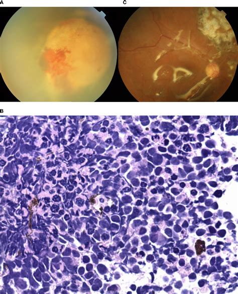 Frontiers Retinoblastoma In Adults Clinical Features Gene Mutations And Treatment Outcomes