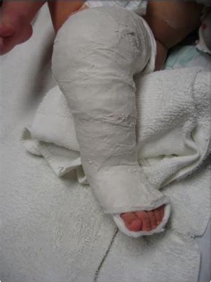 Clubfoot - Clinics in Podiatric Medicine and Surgery