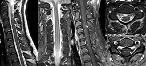 Illustrative 3 T Mri Slices Of The Patients Cervical Spine C1th2 Are