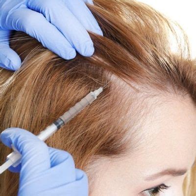 PRP Hair Treatment In Dubai Plasma For Hair Loss