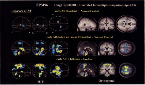 Adjusted Rcbf Increase Shownby Spm In Patientswith Earlyad Comparedwith