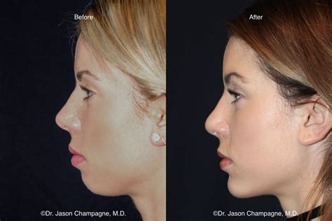 Chin Implant Gallery Beverly Hills Plastic Surgeon Dr Jason Champagne