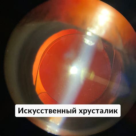 Лечение катаракты в Москве, цены и отзывы на операцию по удалению ...