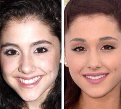 Ariana Grande before and after plastic surgery 02 | Celebrity plastic ...