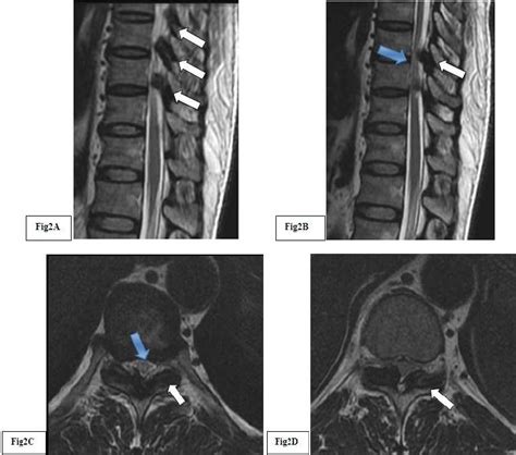 MRI Of Thoracic Spine In T2 Weighted Sequences Sagittal Section A B