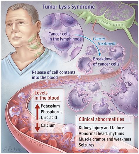 Tumour Lysis Syndrome MEDizzy