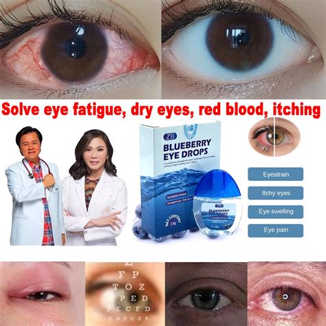 【cod】blueberry Eye Drops Itchy Eyes Glaucoma Eye Drops Dry Eyes Eye Drops Sore Eyes