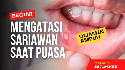 Bikin Nyeri Ini Cara Atasi Sariawan Saat Puasa Youtube