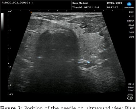 Figure From Ultrasound Study To Validate The Anterior Cervical