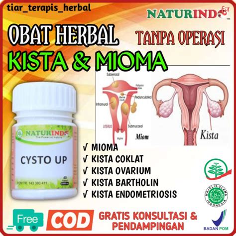 Jual Herbal Obat Miom Kista Ovarium Kista Coklat Kista Endometriosis