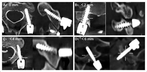 The Gertzbein Robins Classification For Screw Positioning A Grade A Download Scientific