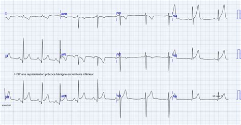 Syndrome De Repolarisation Pr Coce E Cardiogram