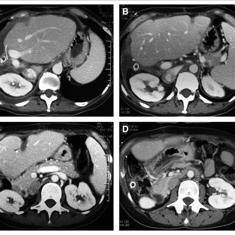 Computed Tomography Of The Liver In A Patient With Initially