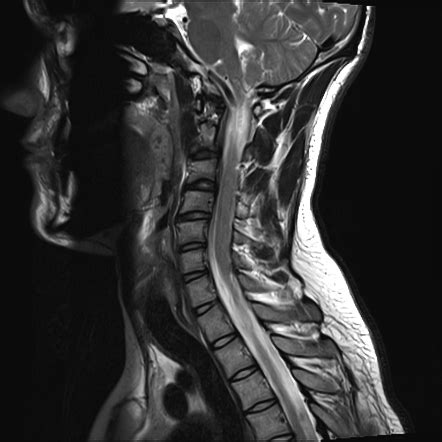 Brachial Plexus Injury With Pseudomeningoceles Radiology Case