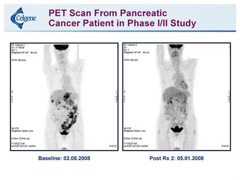 Pet Scan From Pancreaticcancer Patient In Phase Iii Studybaseline 02