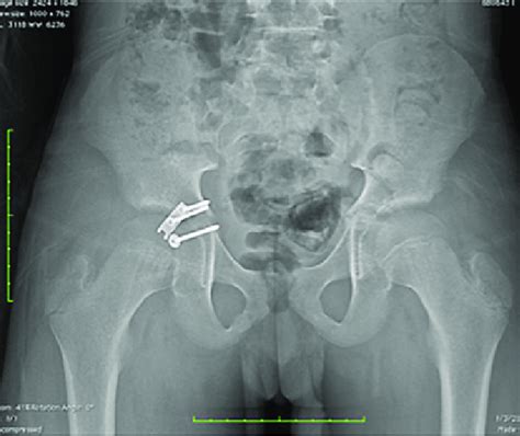 Week Postoperative Ap Pelvis Demonstrating Intact Posterior Wall