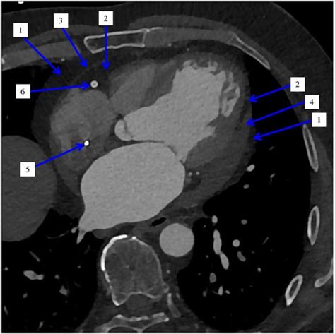 Jcm Free Full Text The Importance Of The Assessment Of Epicardial