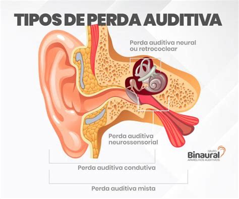 Audiograma Perda Auditiva Condutiva