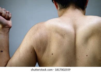 Asian Man Shoulder Dislocation Stock Photo 720789001 Shutterstock