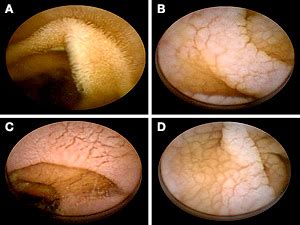 Villi Small Intestine Celiac Disease