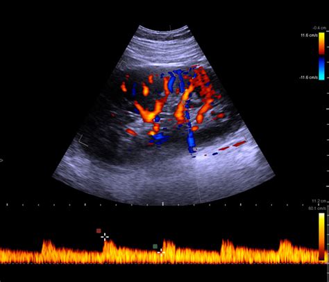 Ultrasound Machines For Kidney Imaging Bk Medical