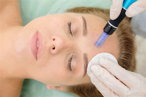 Microneedling A Revolutionary Hair Loss Treatment IGBeauty Blog