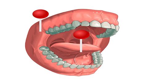 Spaces Of Oral Cavity Sublingual Submental Incision Drainage Dr