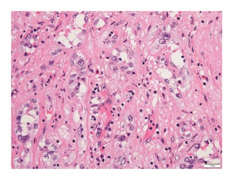 Photomicrographs Of Hepatic Epithelioid Hemangioendothelioma A This Download Scientific