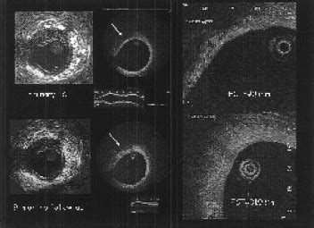 AS 278 Natural Course Of Lipid Rich Plaques Assessed With Combination