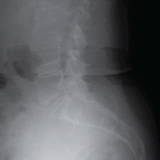 Anteroposterior A And Lateral B Radiograph Of Lumbar Spine In