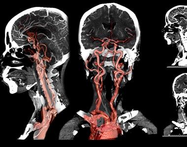 Carotid Artery Disease And Cerebral Angiography Dr Raghu