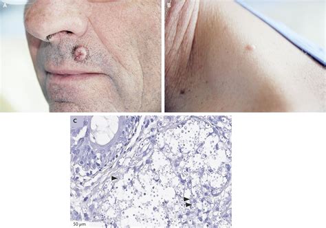 Cryptococcus Skin