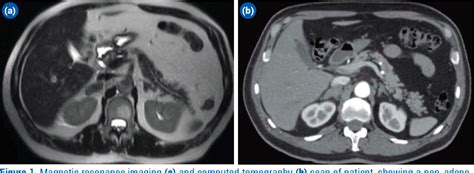 Figure 1 From Laparoscopic Adrenalectomy For Metastatic Adrenal Cancer