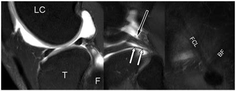 Mr Arthrographic Appearance Of Meniscofibular Ligament Mfibl