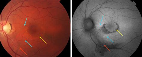 Hydroxychloroquine Retinopathy Correlation Of Fundus Photography And