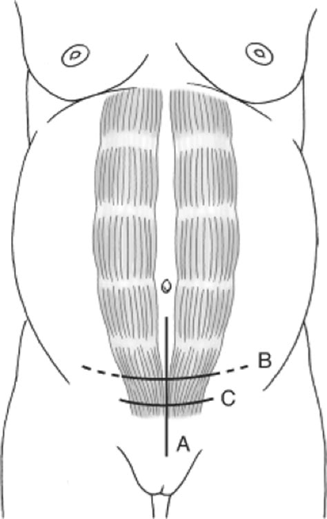 Cesarean Delivery Basicmedical Key