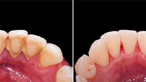 Teeth Cleaning Before And After