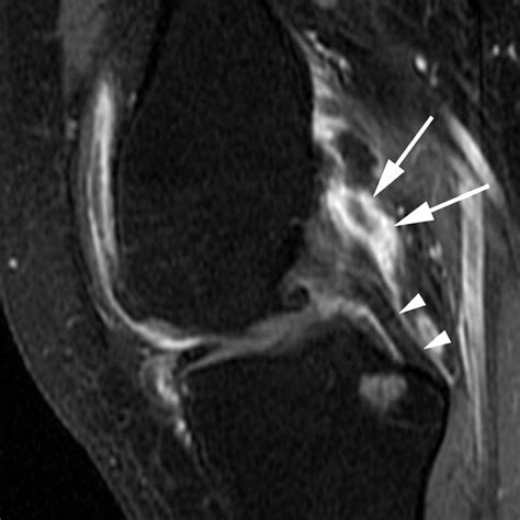 Anatomical Distribution Of Synovitis In Knee Osteoarthritis And Its Association With Joint