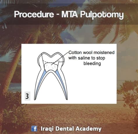 Pulpotomy Procedure For Pediatrics In Detail