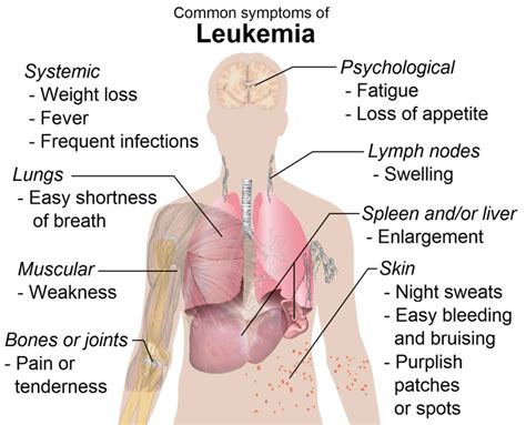 Leukemia Symptoms Diagram Free Health And Medical Pictures Photos