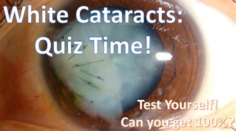 White Cataracts Can You Pass The Quiz Cataract Coach