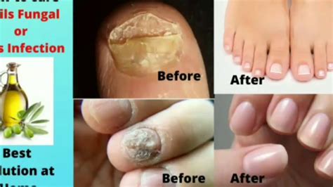 नाखूनो के फंगस का घर पर इलाज Care Toenail Fungal Infection