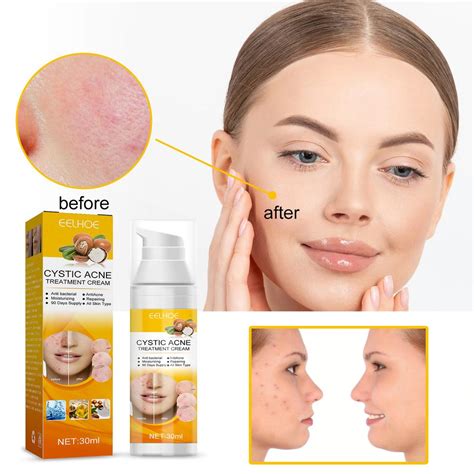 Cheap Eelhoe Herbal Acne Removal Face Cream Oil Control Anti Acne Gel Treatment Acne Mark Skin