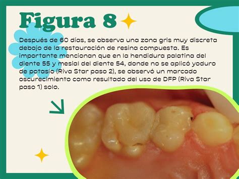 Fluoruro De Plata Diamino RestauraciÓn Dental ¿hay Una JustificaciÓn