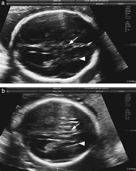 Agenesis Of Corpus Callosum Ultrasound