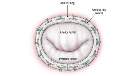 Minimally Invasive Mitral Valve Repair