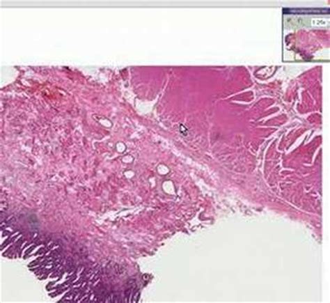 Barrett's Esophagus Histology