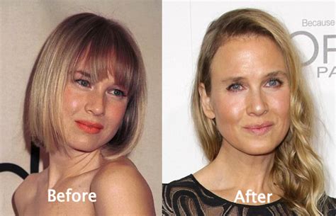 Renee Zellweger Plastic Surgery Before And After Photos